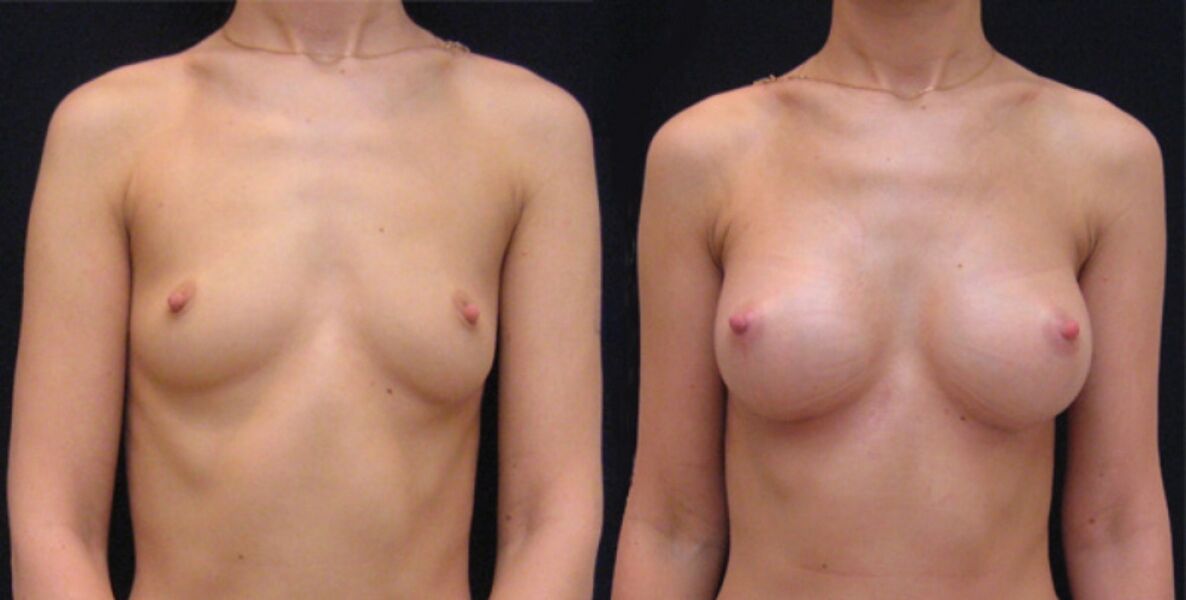 breast before and after endoscopic augmentation