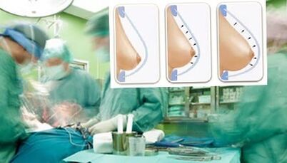 How breast lipilifting is performed