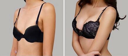 Photo before and after the increase of the breast