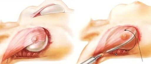 As the breast increase operation is performed