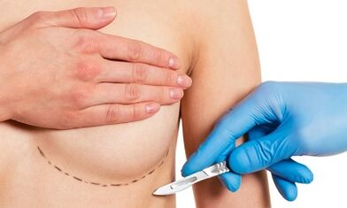 Submmmal access to increased breast with implants