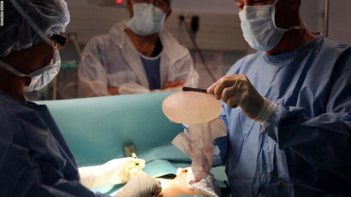 Mammoplasty characteristics