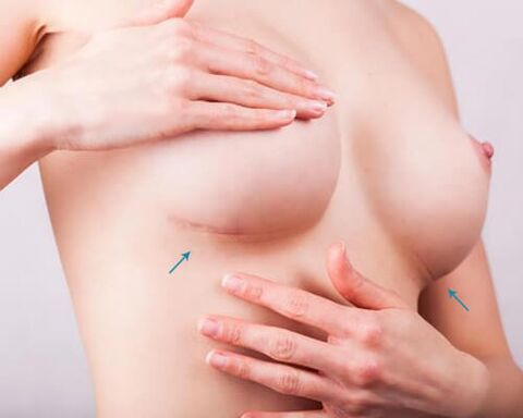 Increased breast with implants