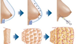 how is the breast augmentation procedure done with fat