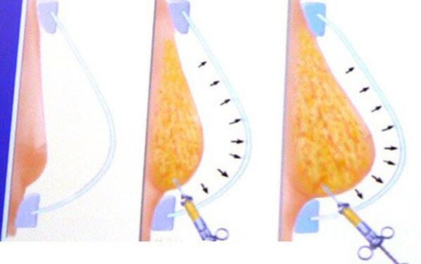 breast enlargement with fat